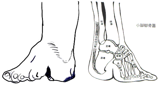 Anatomy of Hallux Valgus