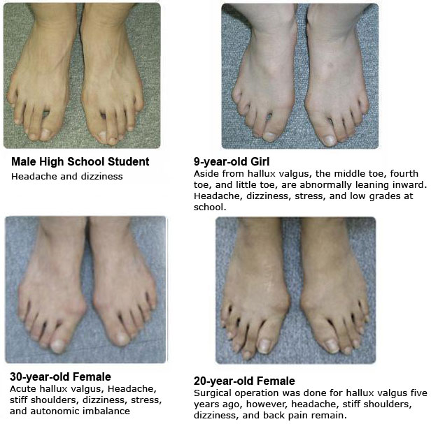 Hallux Valgus Deformity) You Sick