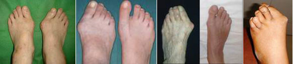 Hallux Valgus