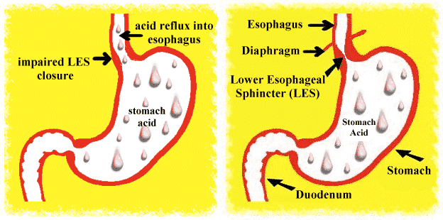 Heartburn