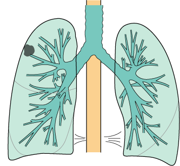 Lung Cancer