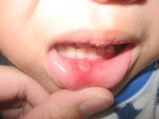 Mouth Ulcer