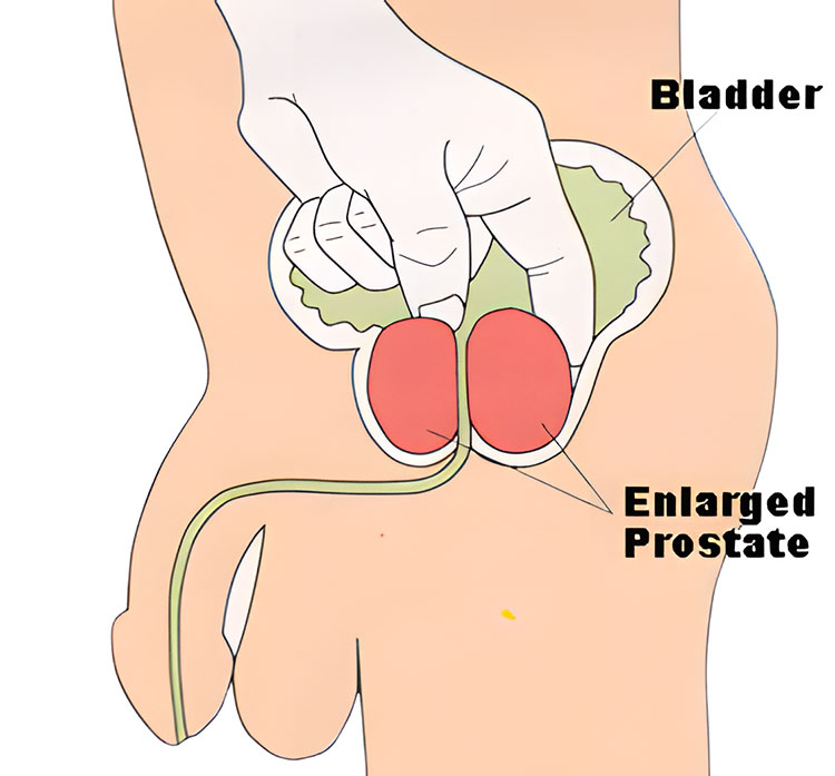 Prostate Enlargement