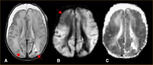 Shaken Baby Syndrome CT Scan