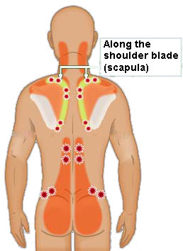 Acupressure Trigger Points