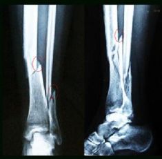 Bone Fracture