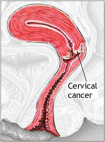 Cervical Cancer