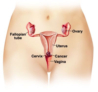 Cervical Cancer