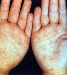 Hand, Foot and Mouth Disease