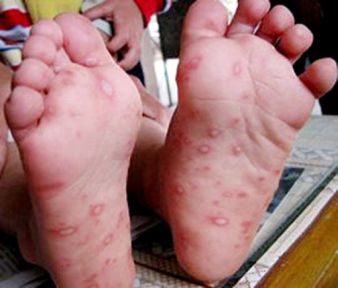 Hand, Foot and Mouth Disease