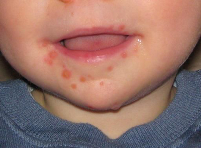 Hand, Foot and Mouth Disease