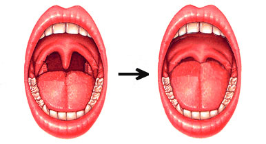 Sleep Apnea Syndrome