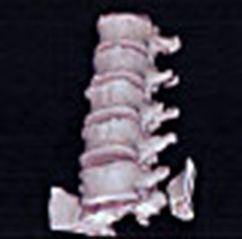 Spinal Fracture