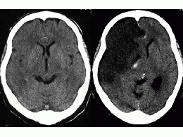 Cerebral Infarction as shown in CT Scan