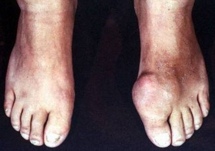 Gout affecting feet