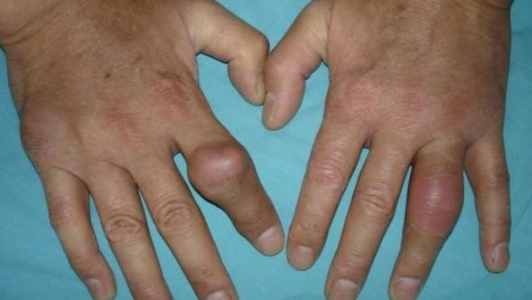 Gout affecting hands