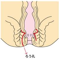 Hemorrhoids