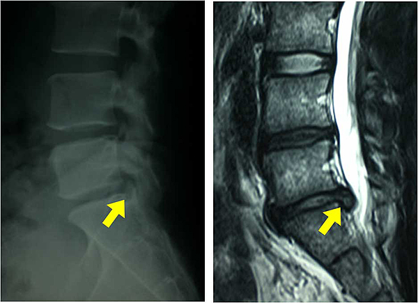 Herniated Spinal Disc