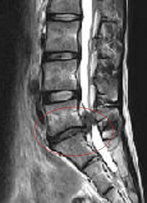 Herniated Spinal Disc