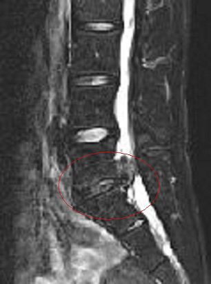 Herniated Spinal Disc