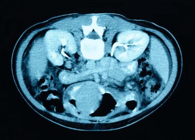 Pancreatitis CT Scan