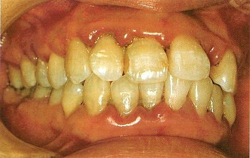 Periodontal Disease