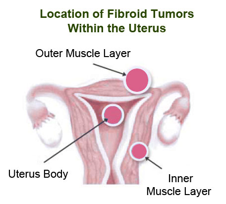 Location of Uterine Fibroid Tumors within the Uterus