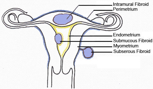 Uterine Fibroids Tumors