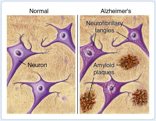 Beta-Amyloid Triggers Alzheimer's Disease