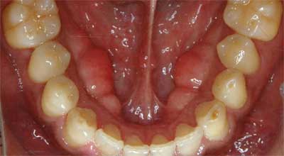 Bruxism causing bony ridges