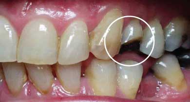 Fractured tooth caused by severe bruxism