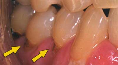 Effect of teeth clenching