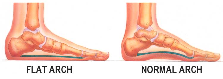 Comparison of Normal and Flat Feet Arch