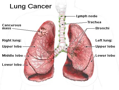 Lung Cancer