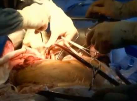 Organ Transplant Surgery