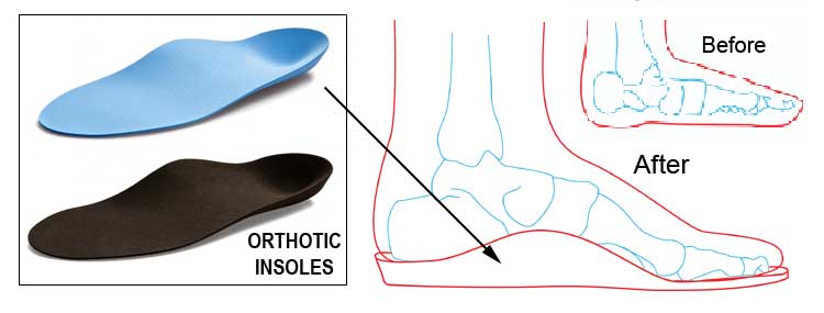 Orthotic Insoles for treating Flat Feet