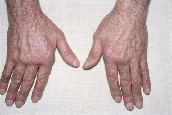 Tenosynovitis