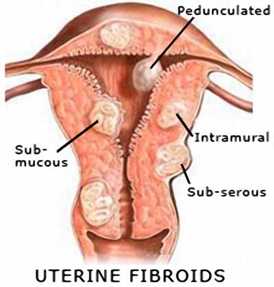 Locations of Uterine Fibroids