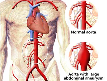 Abdominal Aortic Aneurysm
