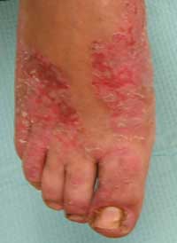 Acrodermatitis Enteropathica