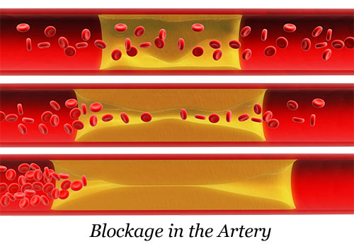 Arteriosclerosis (Hardening or thickening of the arterial walls)