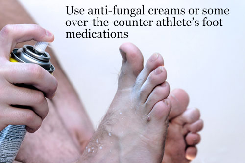 Use antifungal topical creams or over-the-counter athlete's foot medications