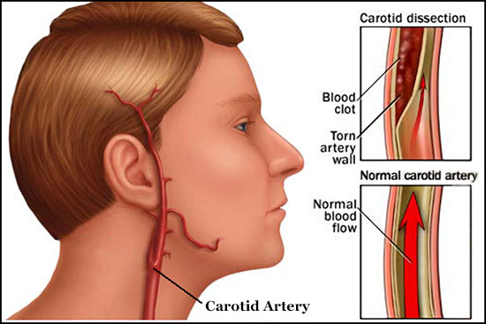 Carotid Artery Dissection