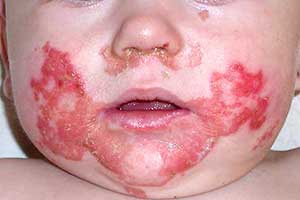 Congenital Zinc Deficiency