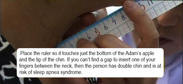 Double Chin and Sleep Apnea Risk