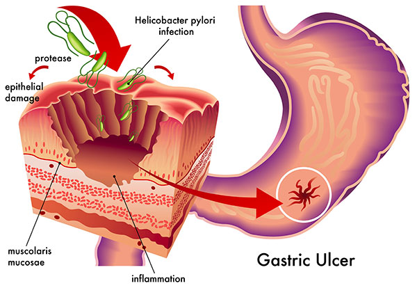 How helicobacter pylori infection causes gastri ulcer