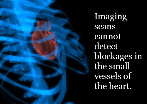 Imaging scans can't detect microvascular angina