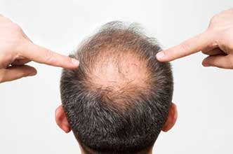 Male Pattern Baldness