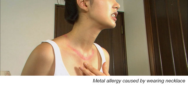 Metal allergy caused by wearing necklace