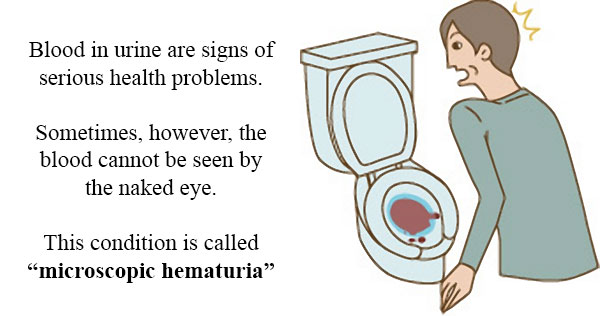 Opposite of Hematuria is Microscopic Hematuria